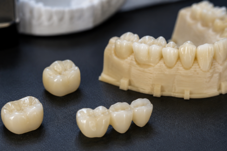 Temporary-restorations