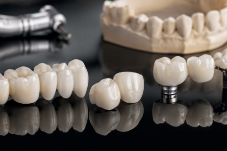 fixed restorations