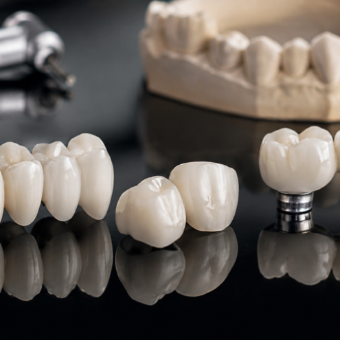 fixed restorations